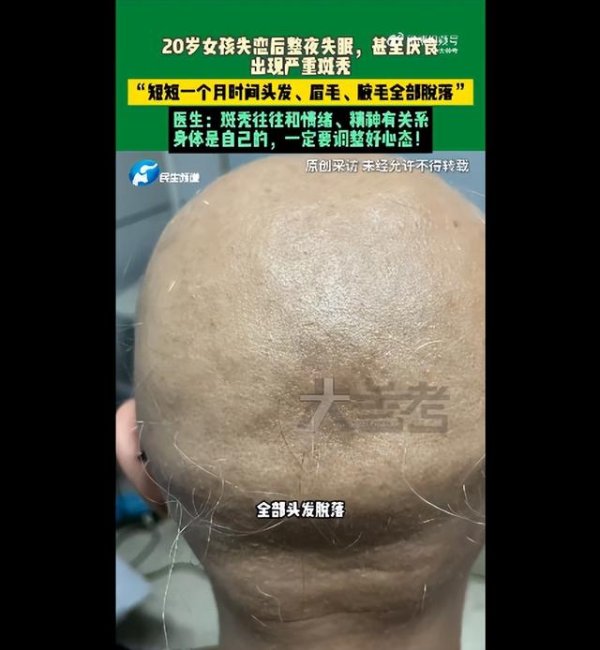 配资之家论坛 20岁女子失恋后整夜失眠，甚至厌食，医生：“短短一个月，头发、眉毛、腋毛全部脱落”
